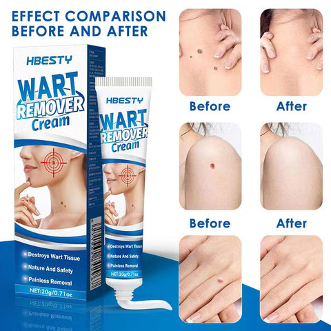 Skin Tag Remover Cream Mole Skin Dark Spot Warts Remover Serum Painless Freckle Face Wart Tag Treatment Removal 20g EssentialOil