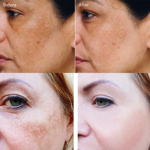Beyprern Effective Whitening Freckle Cream Remove Dark Spots Melasma Melanin Fade Acne Scars Pigmentation Anti-Aging Brighten Skin Care
