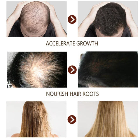 Beyprern 5PCS Hair Growth Essential Oils Hair Care Essence Improve Hair Loss Treatment Liquid Beauty Dense Hairs Growth Serum Health Care