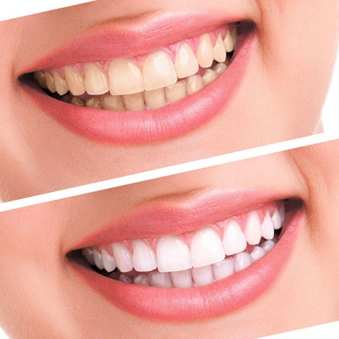 LED Teeth Whitening Light Dental Material Bleach Tooth Gel Tools Whitener Teeth Professional Treatment Clean Oral Hygiene Care