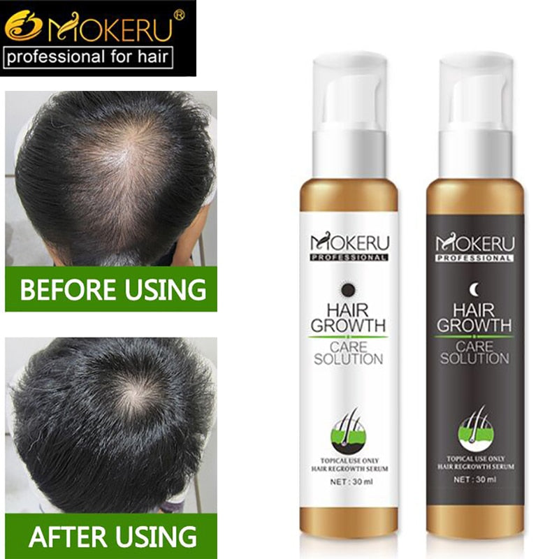 Mokeru Professional Hair Care Growth Hair ReGrowth Lotion Natural Essence Anti Hair Loss Products Hair Treatment Baldness