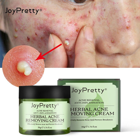 Acne Treatment Face Cream Oil Control Shrink Pores Remove Freckles Cream Skin Face Care Beauty Products