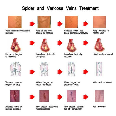 20g Varicose Veins Treatment Cream For Vasculitis Phlebitis Blood Vessel Rotten Legs Angiitis Ointment Medical Plaster