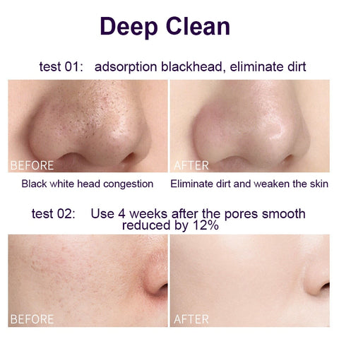 Beyprern 10 Pieces Eggplant Yeast Clear Mud Face Mask Anti Freckle Shrink Pores Acne Blackhead Treatment Moisturizing Whitening Skin Care
