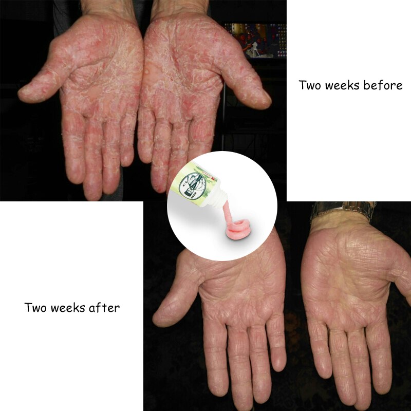 Natural Herbal Skin Psoriasis Cream Dermatitis Eczematoid Eczema Ointment Treatment Psoriasis Cream Skin Care Cream