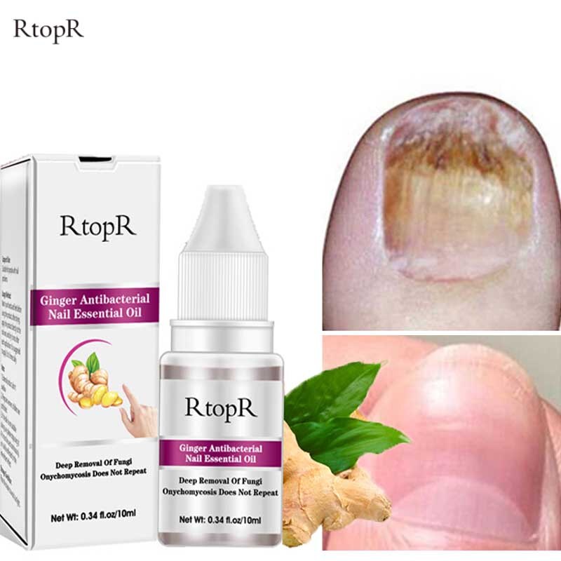 Nails Fungus Treatments Ginger Anti-Fungal Feet Care Cuticle Oil Gel Nail Polish Remover Anti Infection Paronychia Onychomycosis