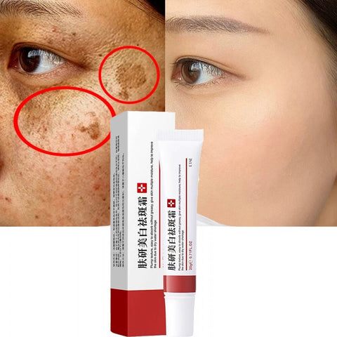 Beyprern Effective Freckle Cream Remove Dark Spots Witening Cream Fade Acne Scars Melanin Pigmentation Melasma Anti-Aging Skin Lightening