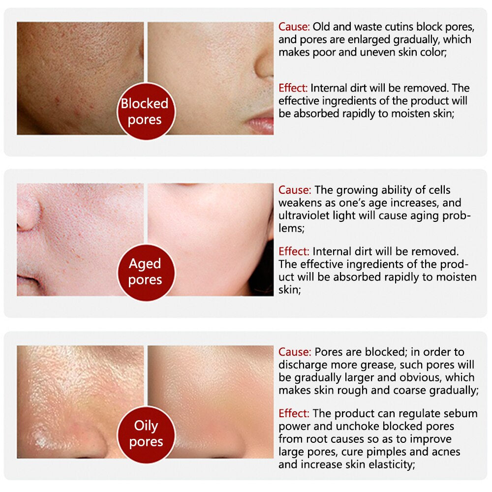 LANBENA Pore Treatment Serum Essence Shrink Pores Relieve Dryness Oil Control Firming Moisturizing Repairing Smooth Skin Care