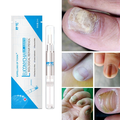 Beyprern Good Result Nail Treatment Pen Onychomycosis Paronychia Anti Fungal Nail Infection Chinese Herbal Toe Nail Fungus Treatment