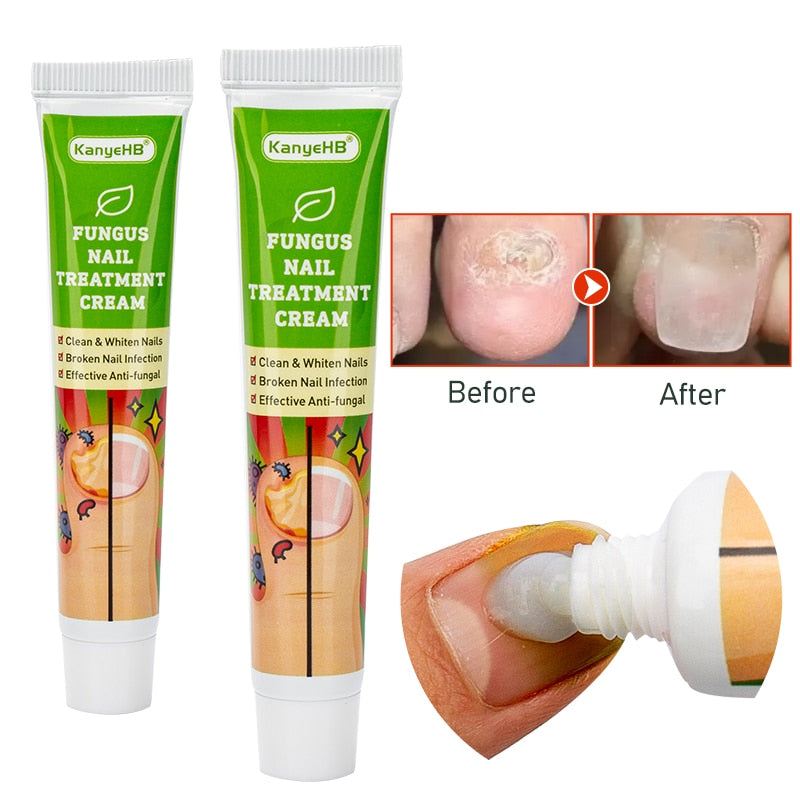 1pcs Nail Fungus Treatment Cream Removal Nail Paronychia Onychomycosis Ointment Feet Whitening Toe Care Plaster G004