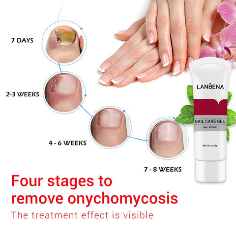 LANBENA Nail Care Gel Fungal Nail Treatment Remove Onychomycosis Nail Care Nourishing Effective Against Nail Hand And Foot Care