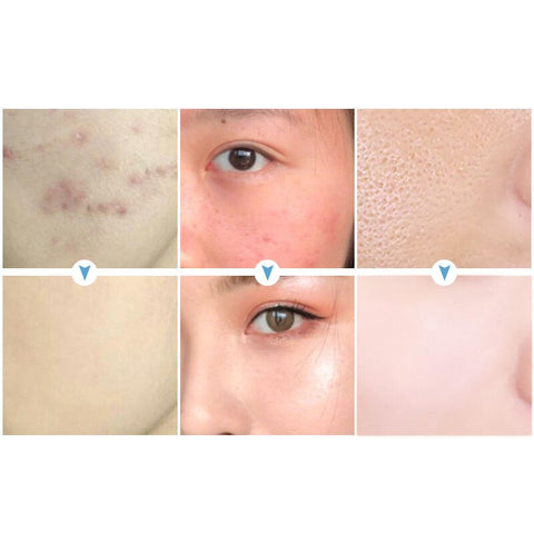 Effective Acne Removal Cream Acne Treatment Fade Acne Spots Oil Control Shrink Pores Whitening Moisturizing Acne Cream Skin Care