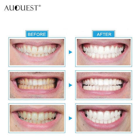 LED Teeth Whitening Light Dental Material Bleach Tooth Gel Tools Whitener Teeth Professional Treatment Clean Oral Hygiene Care
