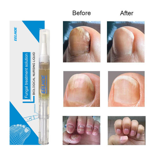 Beyprern Fungal Nail Treatment Feet Care Serum Toe Fungus Pen Nail Cuticle Oil Anti Infection Paronychia Onychomycosis Nourish Foot Care