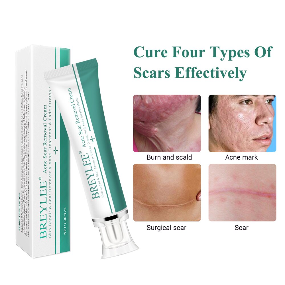 Beyprern Scar Removal Cream Face Cream Scar Stretchmarks Spots Remover Cream Skin Repair Acne Treatment Whitening Body Cream 30g