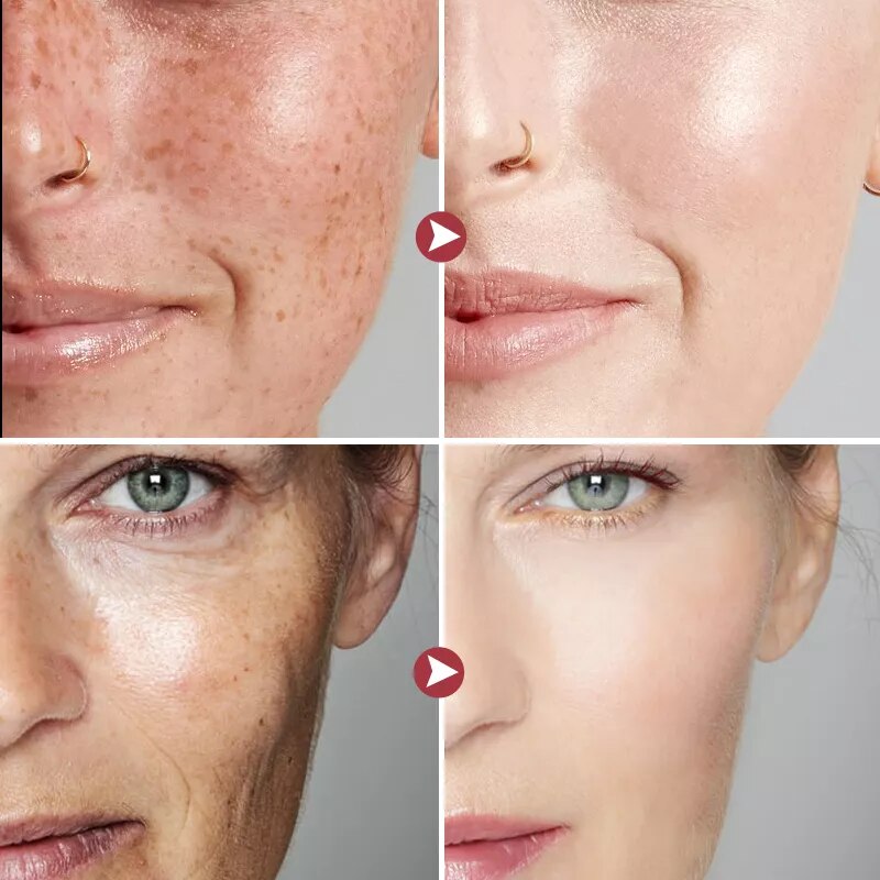 Niacinamide Whitening Freckle Cream Dark Spots Remove Skin Care Product Pigment Correction Moisturizing Brighten Beauty Cosmetic