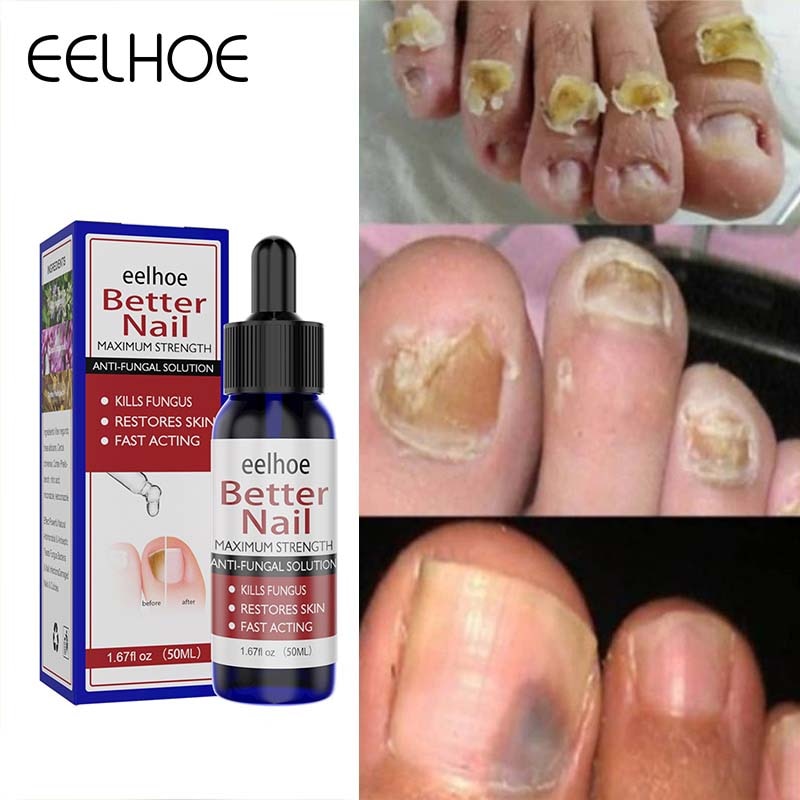 Nail Fungus Treatment Serum Hand Foot Care Fungal Removal Essence Anti Infection Paronychia Onychomycosis Feet Repair Products
