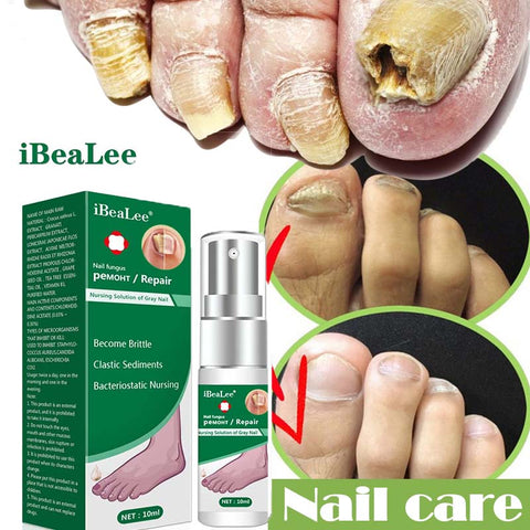Beyprern Nails Fungus Treatment Foot Anti Infection Repair Essence Cuticle Oil Nail Polish Remover Onychomycosis Feet Beauty Health Care