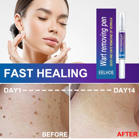 Beyprern Wart Removal Pen Treatment Filamentous Warts Freckle Mole Correcting Blemishes Softening Keratin Essence Painless Face Body Care