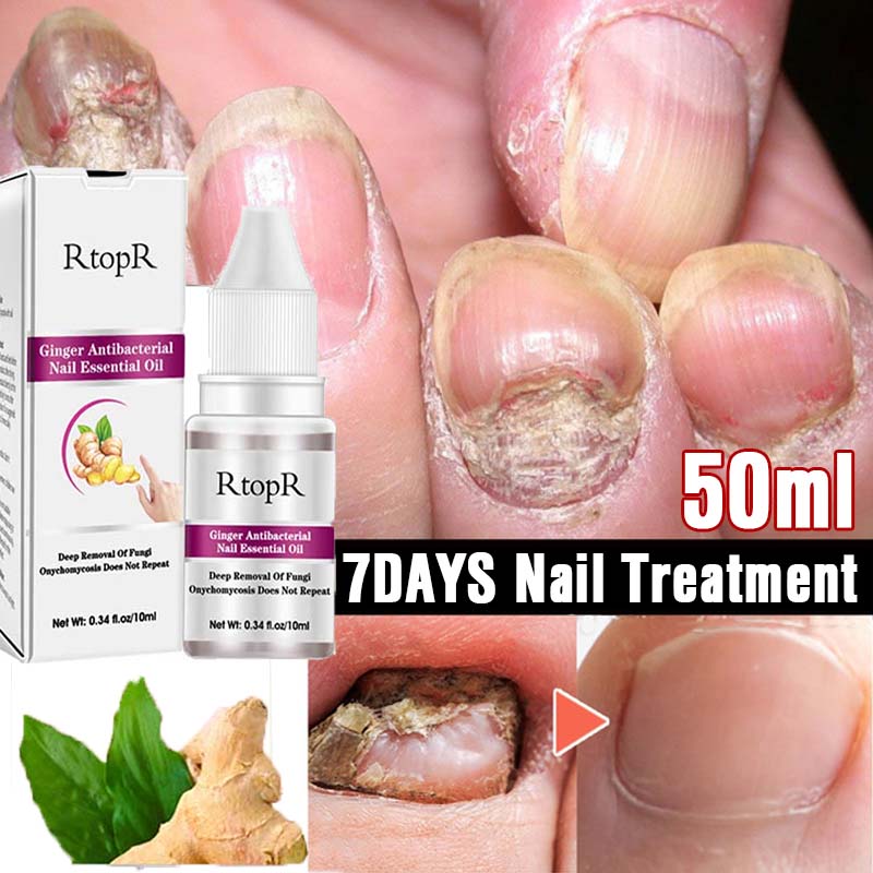 Nails Fungus Treatments Ginger Anti-Fungal Feet Care Cuticle Oil Gel Nail Polish Remover Anti Infection Paronychia Onychomycosis