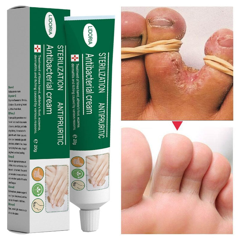 Beyprern Herbal Foot Fungus Removal Cream Nail Care Ointment Anti Fungal Infection Onychomycosis Paronychia Toe Fungus Repair Feet Care