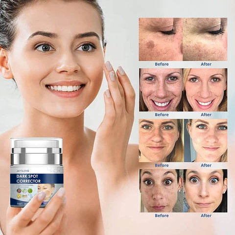 Beyprern Nicotinamide Whitening Freckles Cream Remove Dark Spots Sunburn Spots Age Spots Repair Anti-Aging Moisturizer Brighten Skin Care
